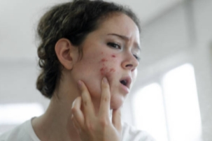 acne and eczema